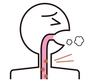 長引く咳